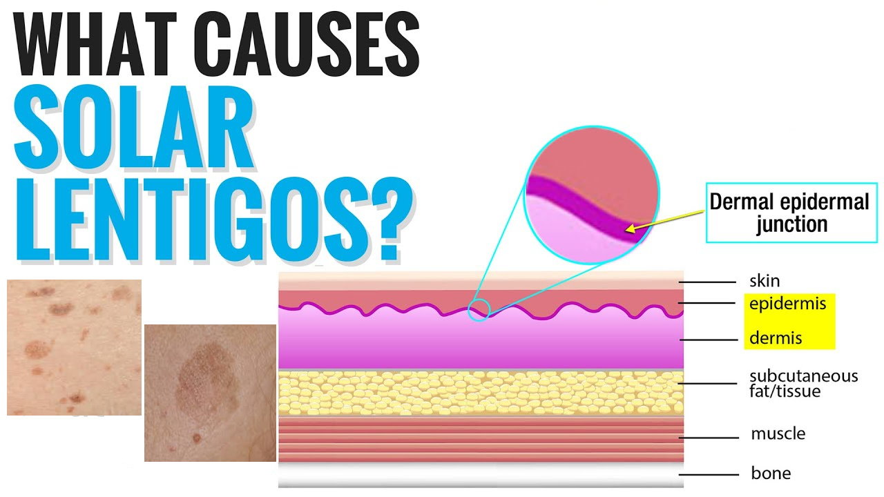 孚立美“氟轻松氢醌维A酸乳膏”能用于老年斑治疗吗？