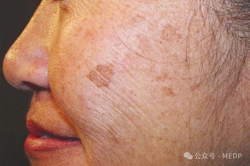 老年斑、晒斑、日光性雀斑是一回事吗？